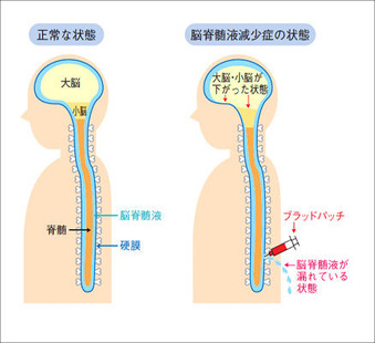 脳脊髄液減少症とブラッドパッチ療法